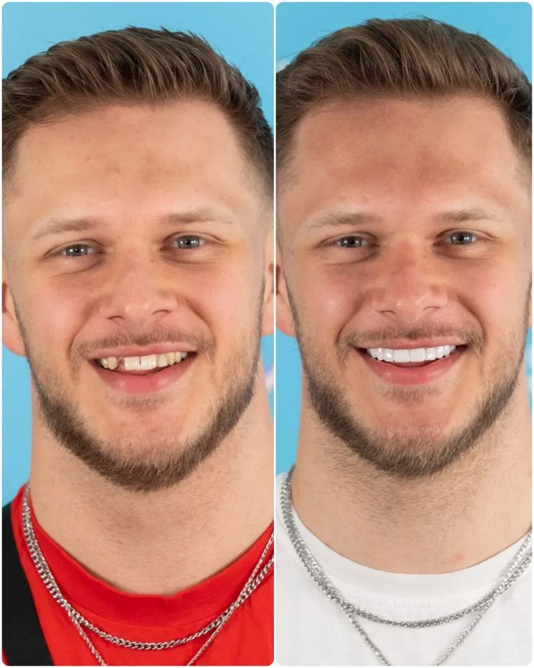 Man with a gap in his front teeth before and a full even smile after
