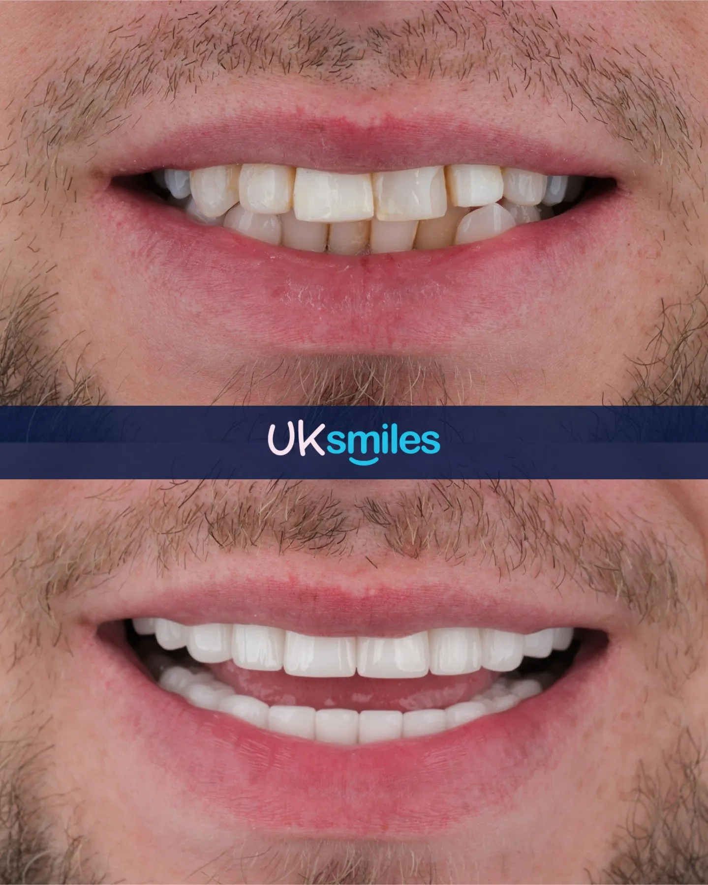 Close-up of uneven, chipped teeth before and straight white teeth after