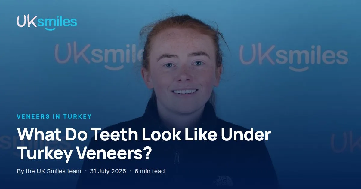 What teeth look like under Turkey veneers: article banner with the guide title over a veneers result at UK Smiles in Antalya