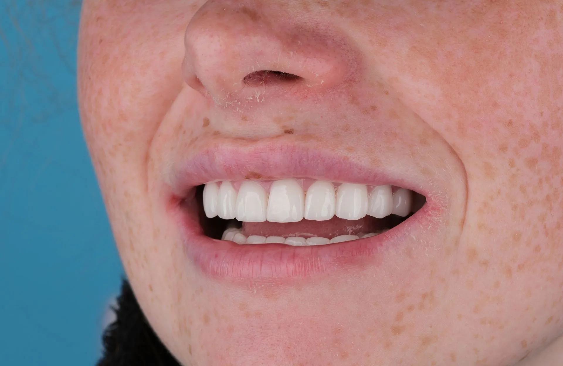 Close-up of a bright white smile after treatment at UK Smiles