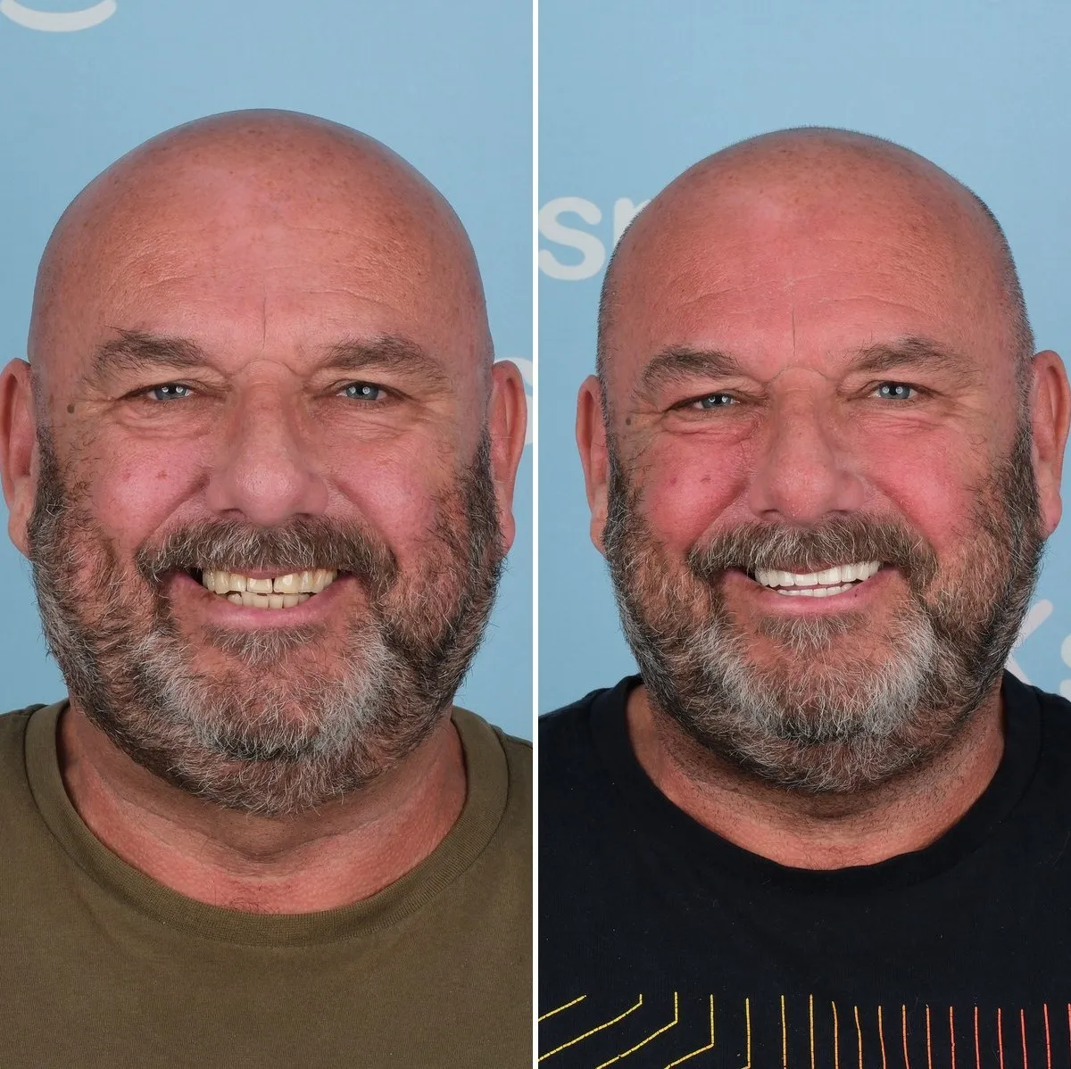 William before and after zirconia crowns with UK Smiles