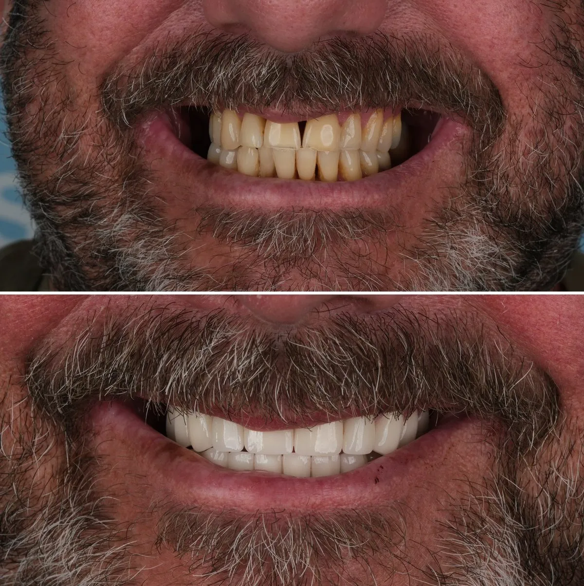 Close-up of William's teeth before and after Zirconia Crowns, view 1