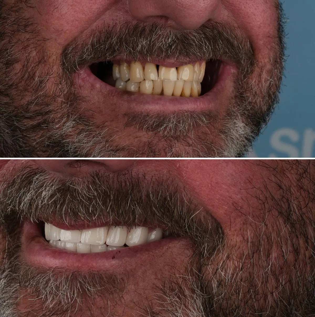 Close-up of William's teeth before and after Zirconia Crowns, view 2