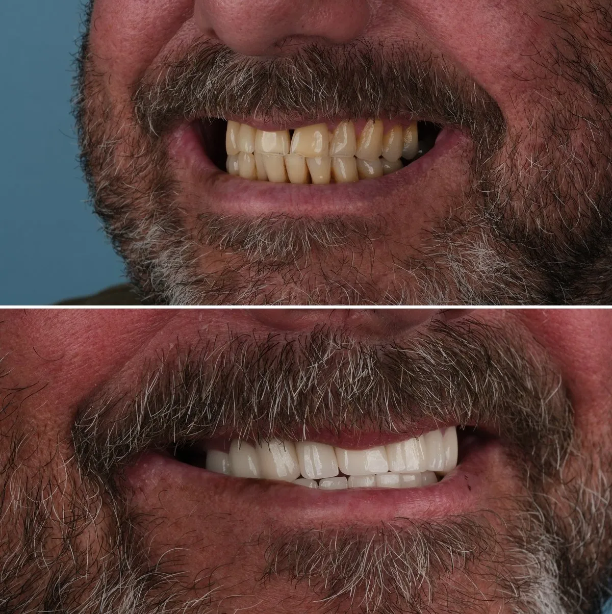 Close-up of William's teeth before and after Zirconia Crowns, view 3
