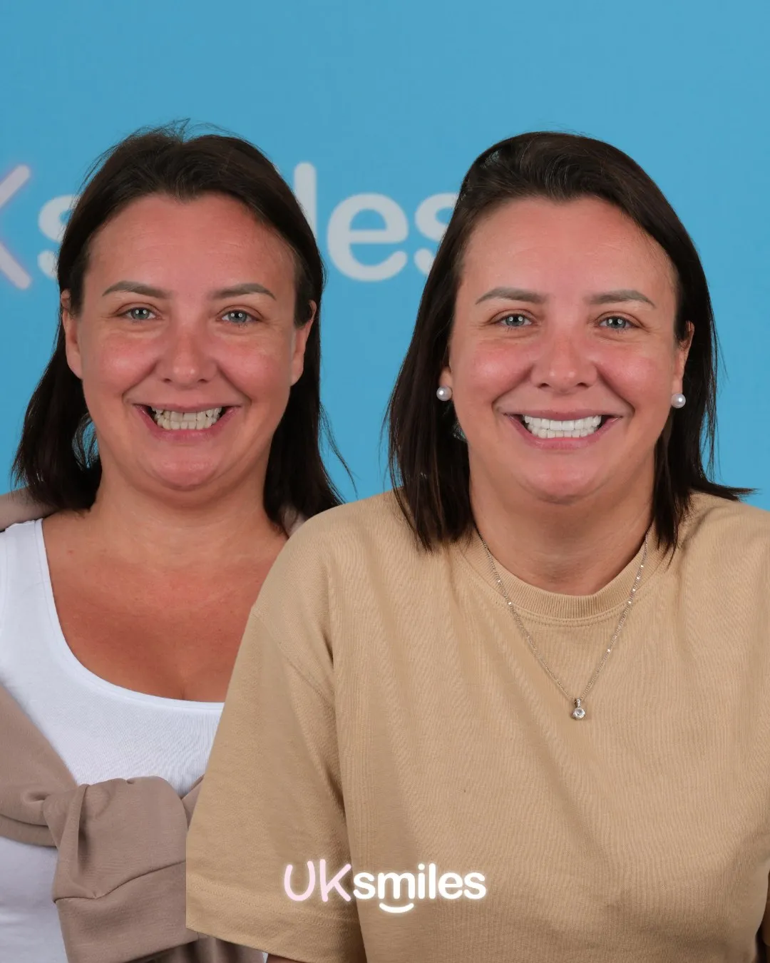 Woman in a beige top before and after her new smile in Turkey