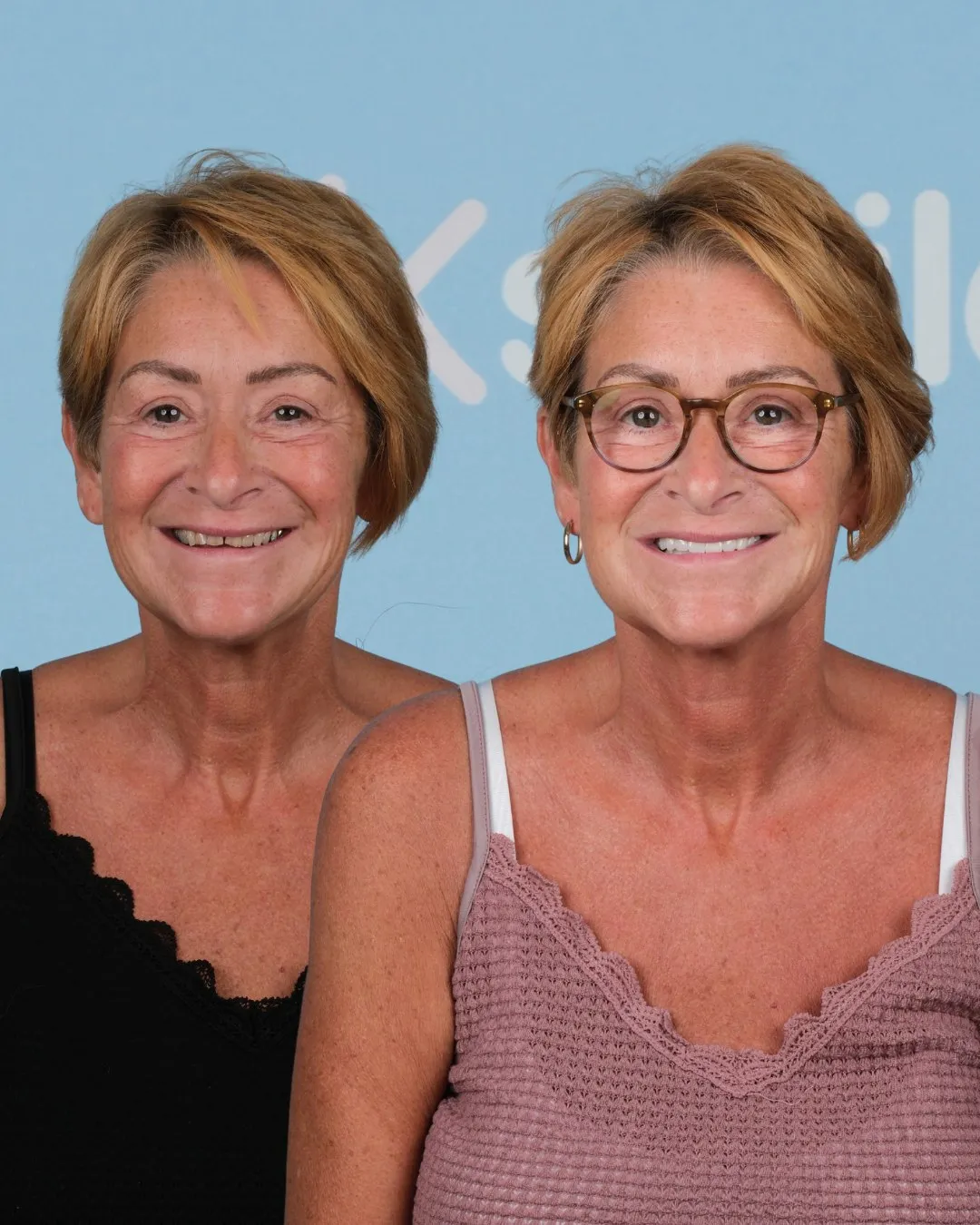 Woman with auburn hair and glasses before and after her new teeth