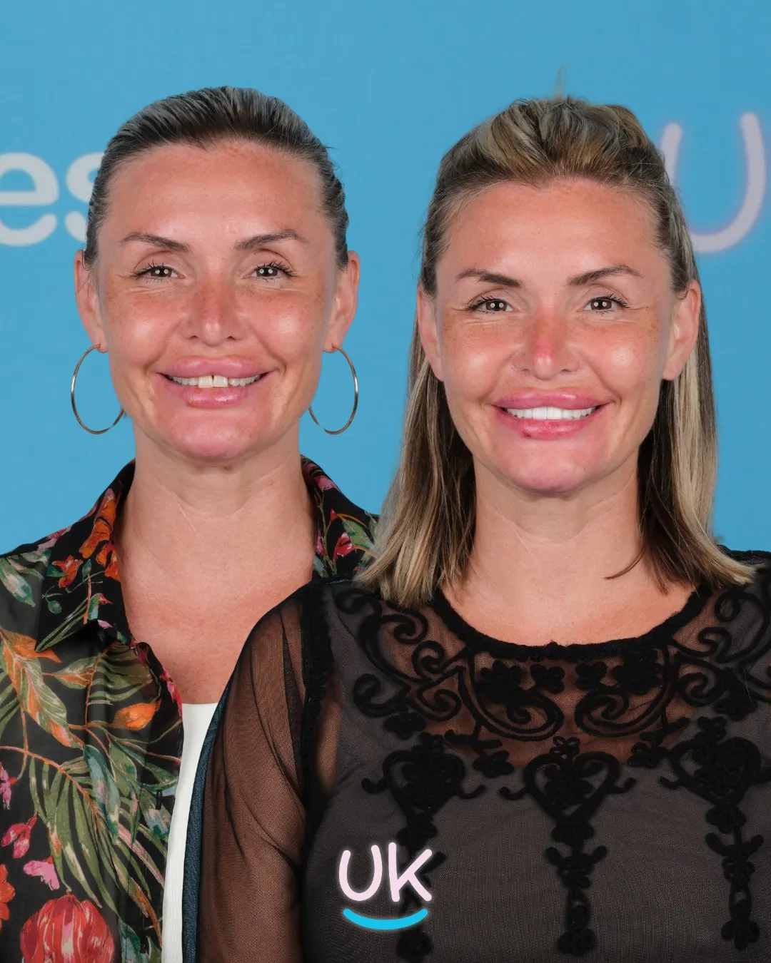 Woman with hoop earrings before and after her new smile in Antalya