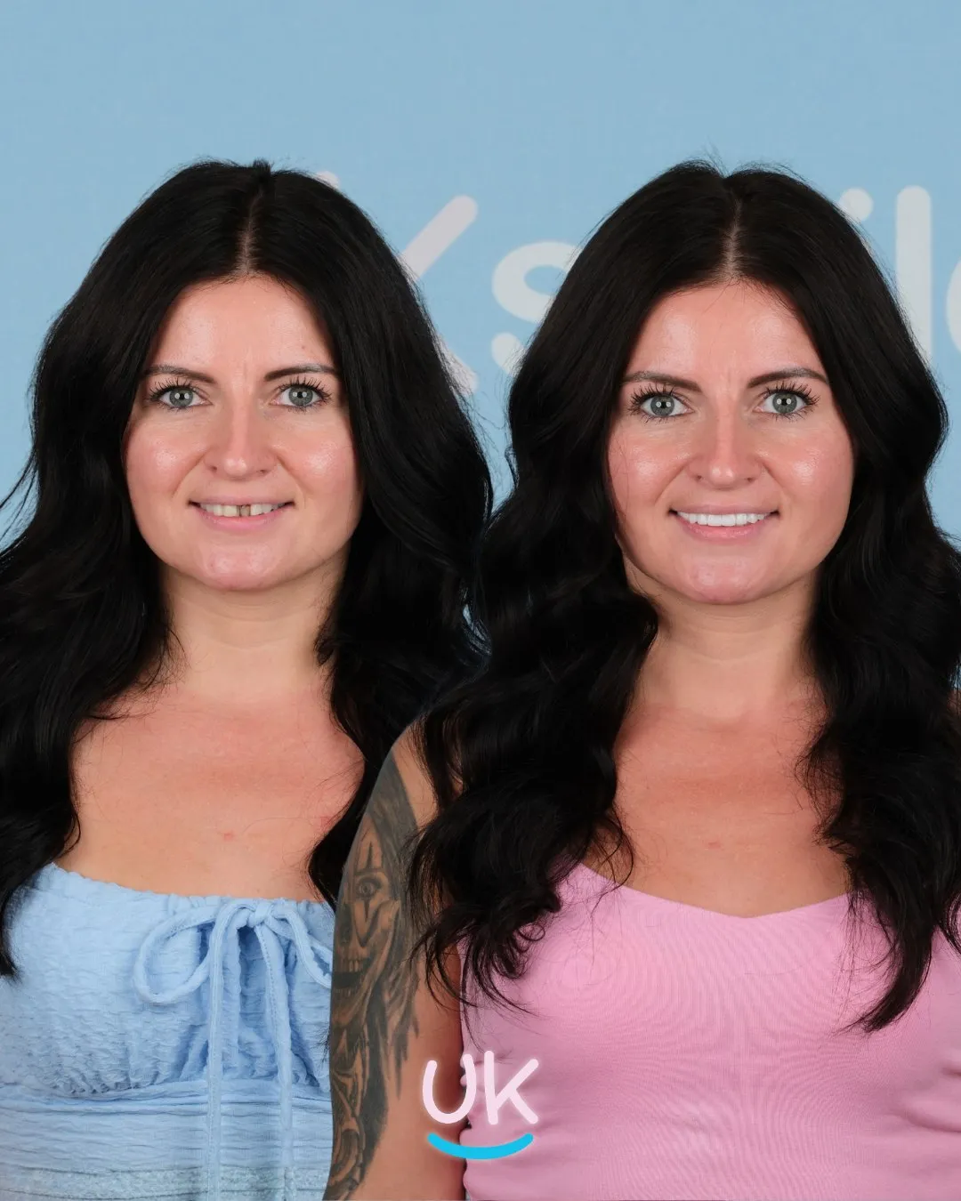Woman with long dark hair before and after brighter, even teeth at UK Smiles