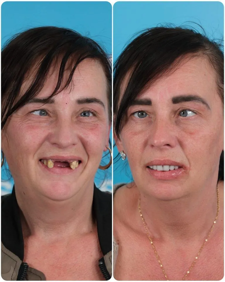 Woman with missing front teeth before and a full new smile after treatment in Turkey