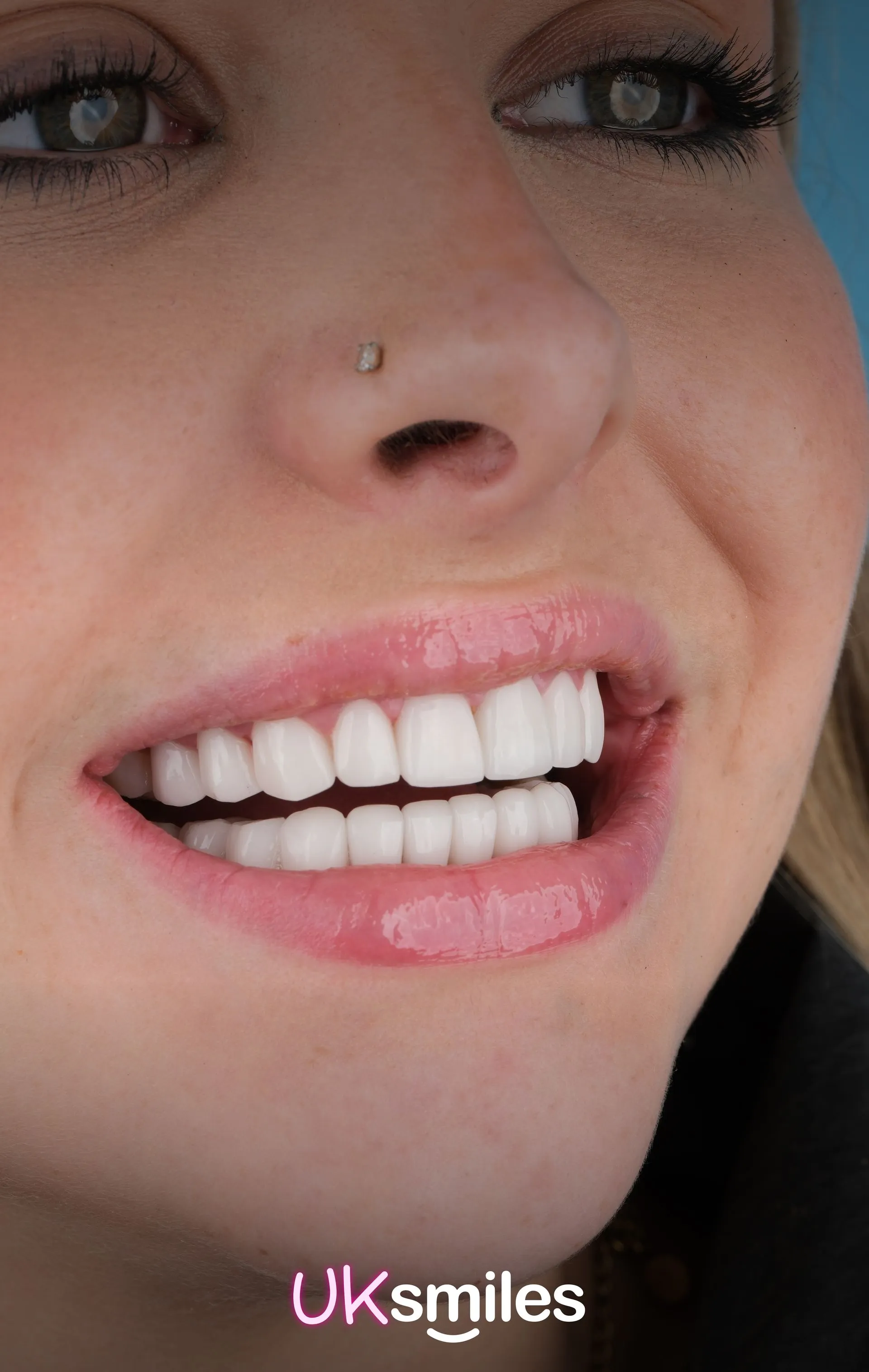 Close-up of a woman with a nose stud showing her new white smile