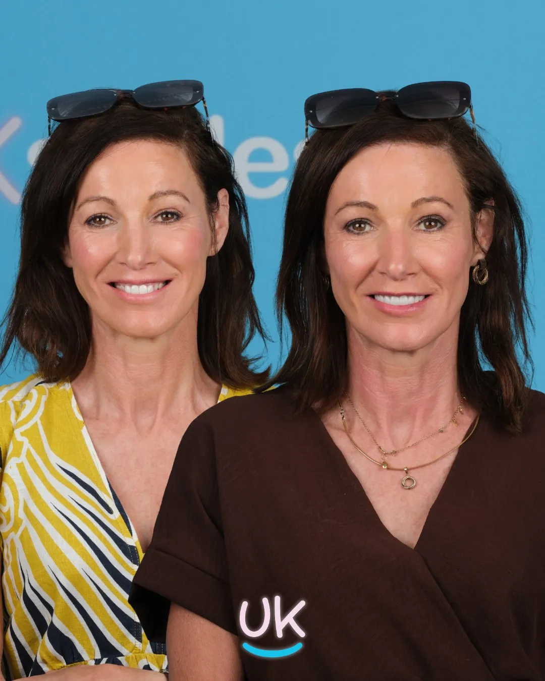 Woman with sunglasses on her head before and after her smile makeover in Antalya