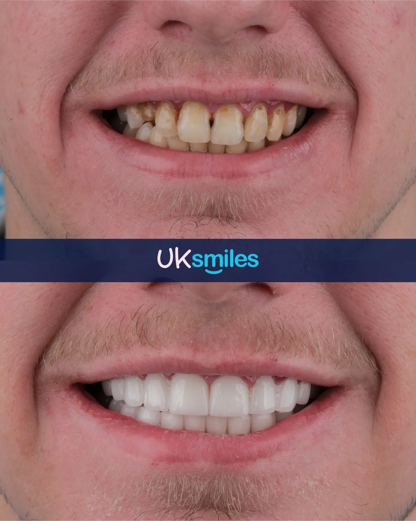 Close-up of yellow, uneven teeth before and an even white smile after
