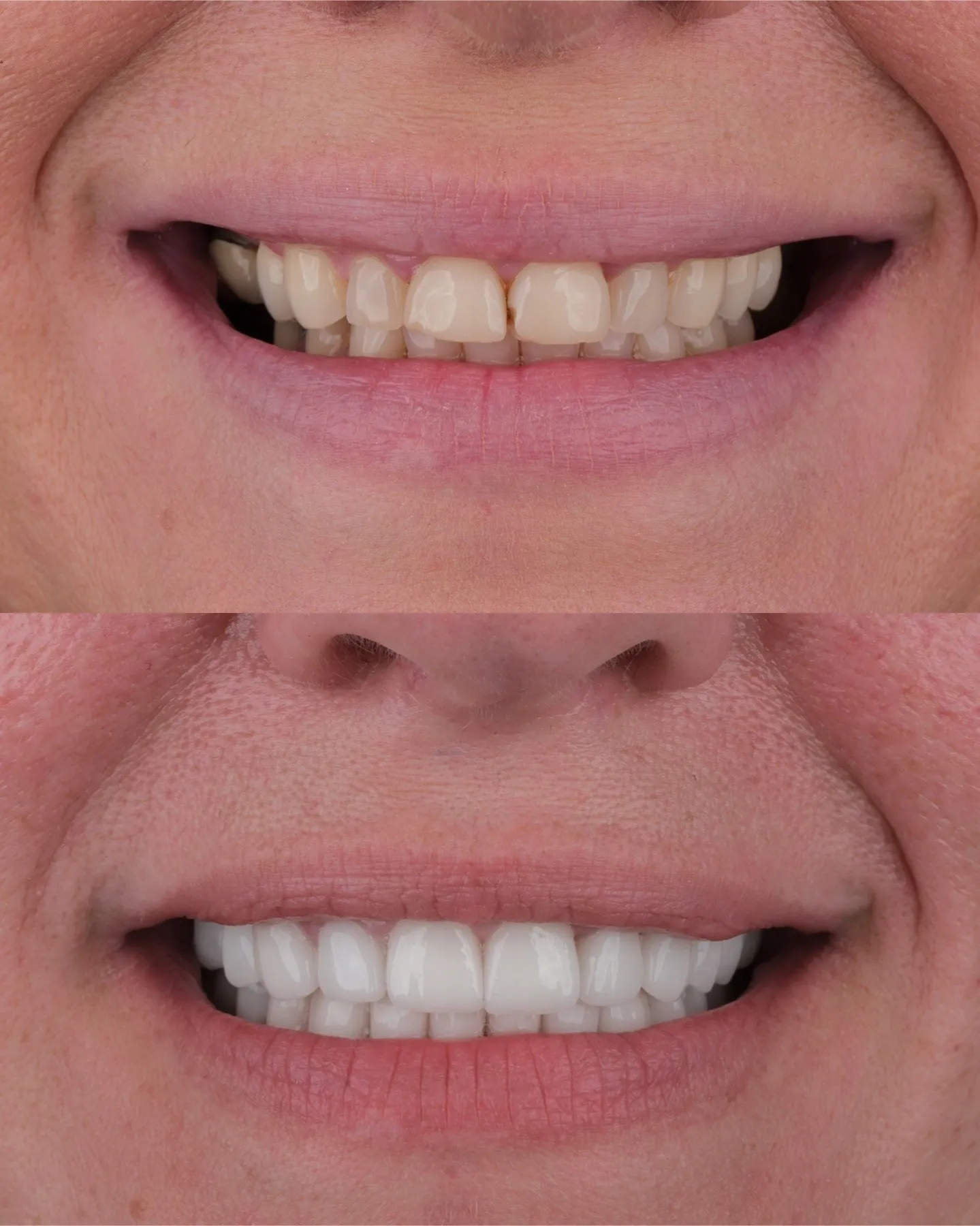 Close-up of yellowed, uneven teeth before and bright, even teeth after treatment