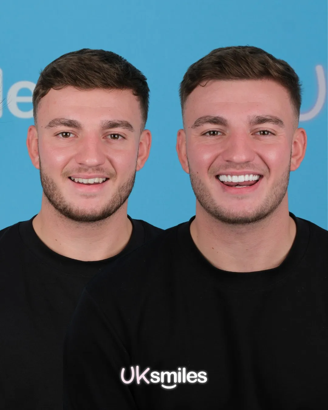 Young man in a black T-shirt before and after his smile makeover