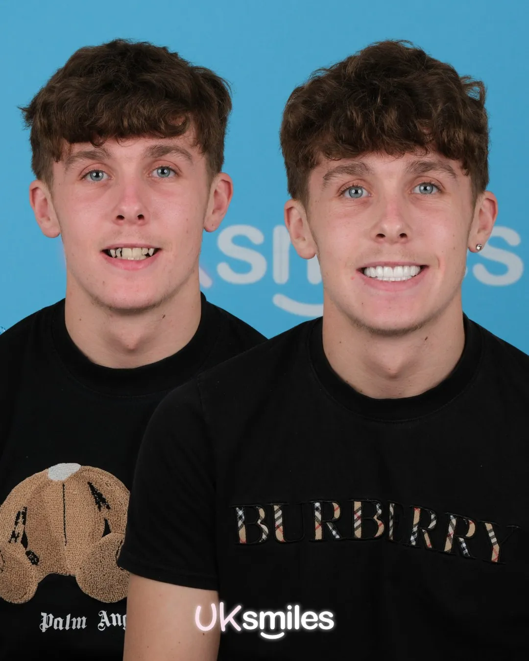 Young man in a Burberry T-shirt before and after his new smile
