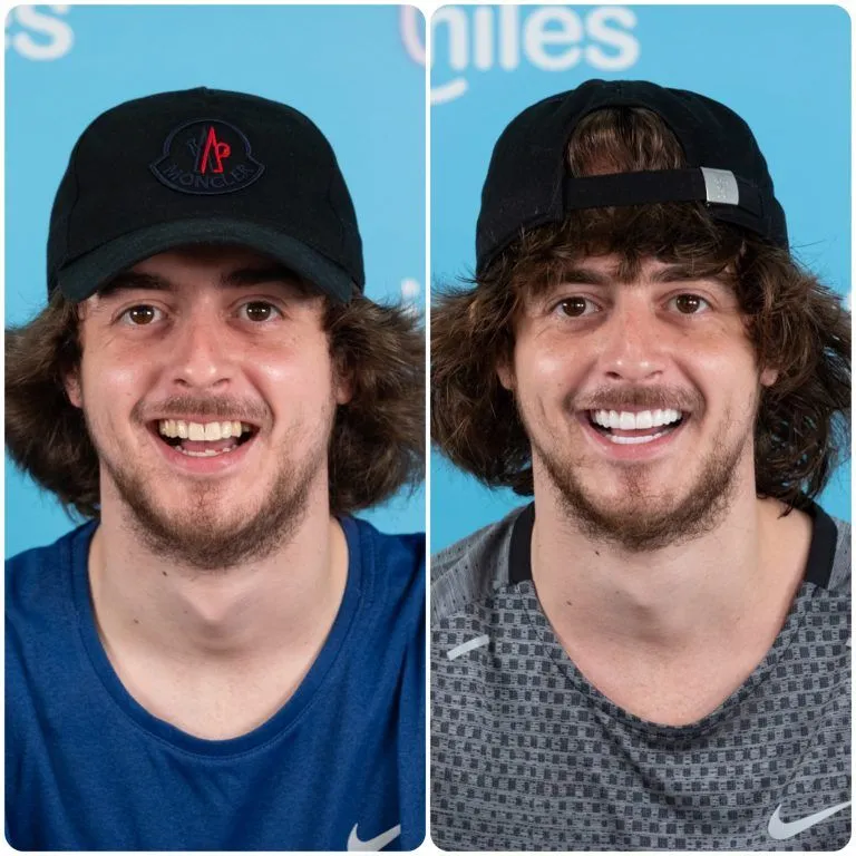 Young man with curly hair and a cap before and after his new smile
