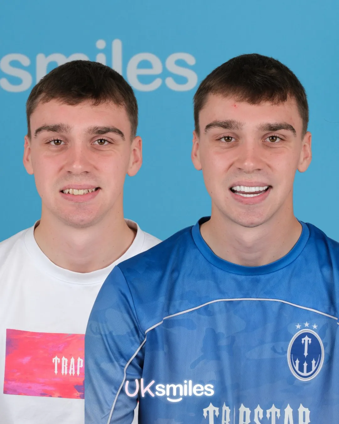 Young man in a blue football shirt before and after his new teeth