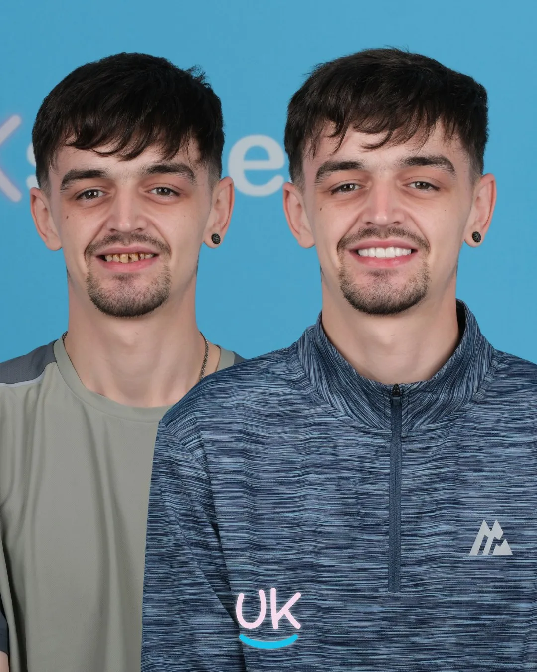 Young man with gapped, uneven teeth before and a straight white smile after treatment