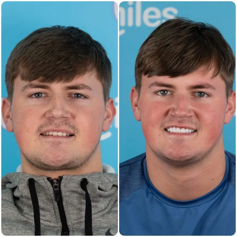 Young man in a grey hoodie before and after his new teeth