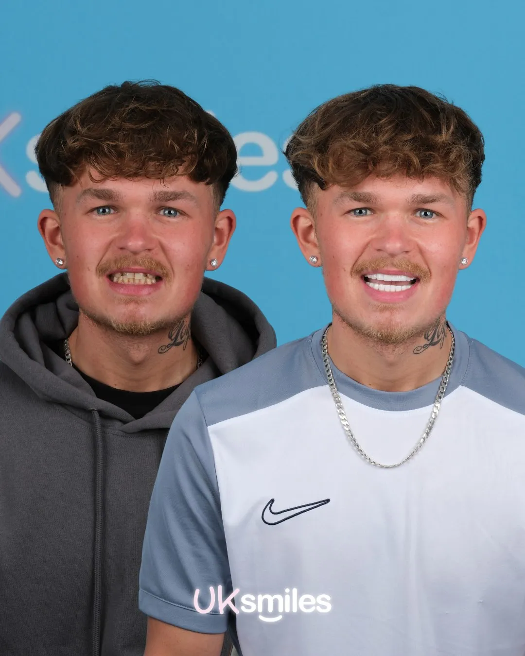 Young man in a grey hoodie with damaged teeth before and a white smile after treatment