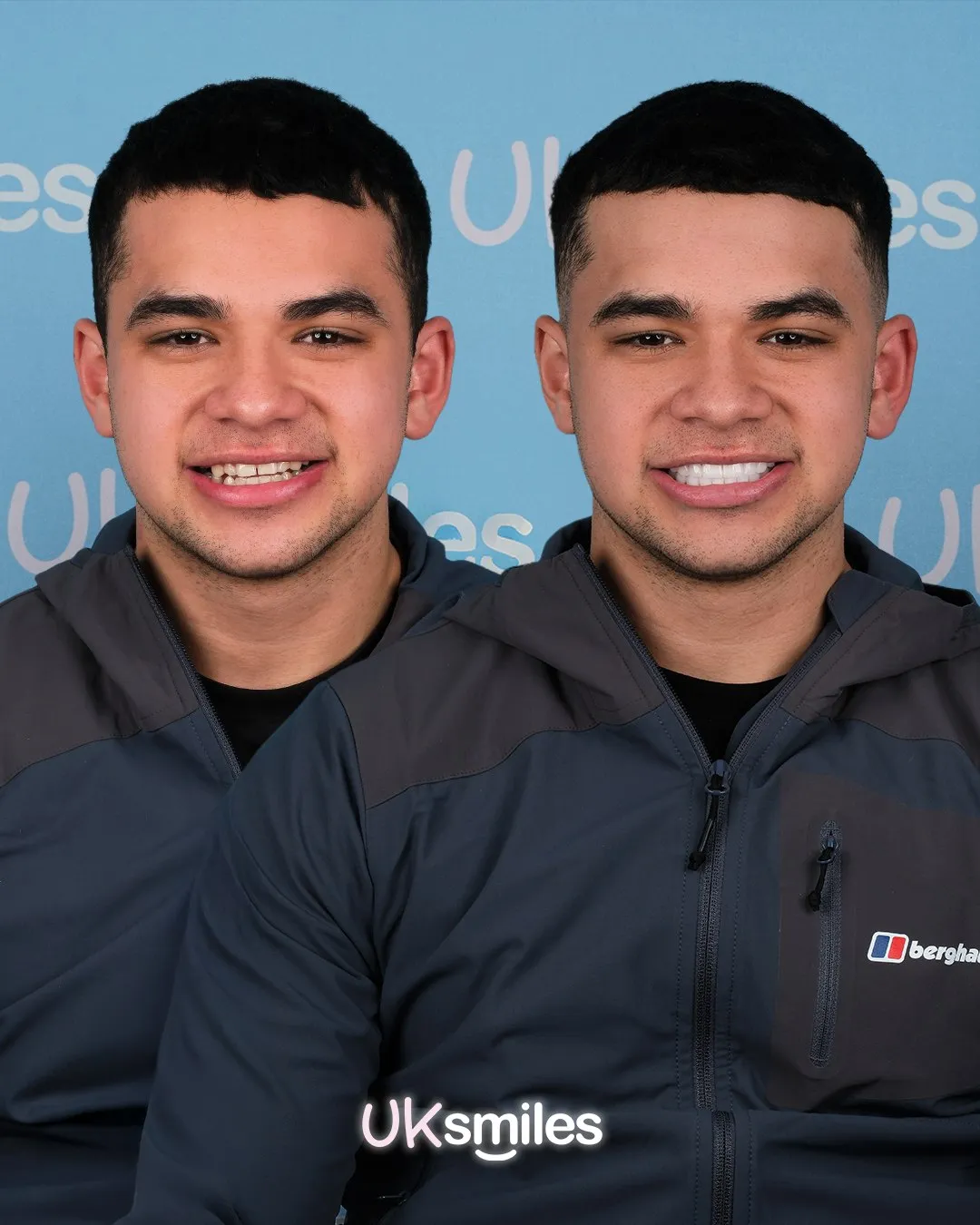 Young man in a grey jacket before and after brighter, straighter teeth