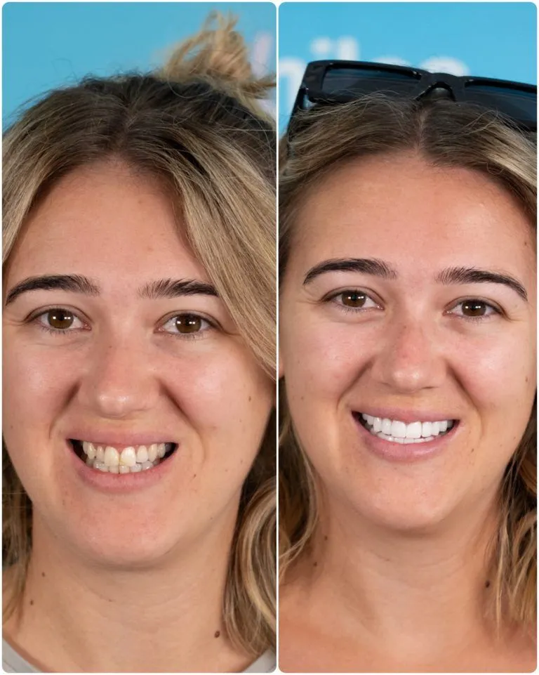 Young woman before and after her new teeth in Antalya