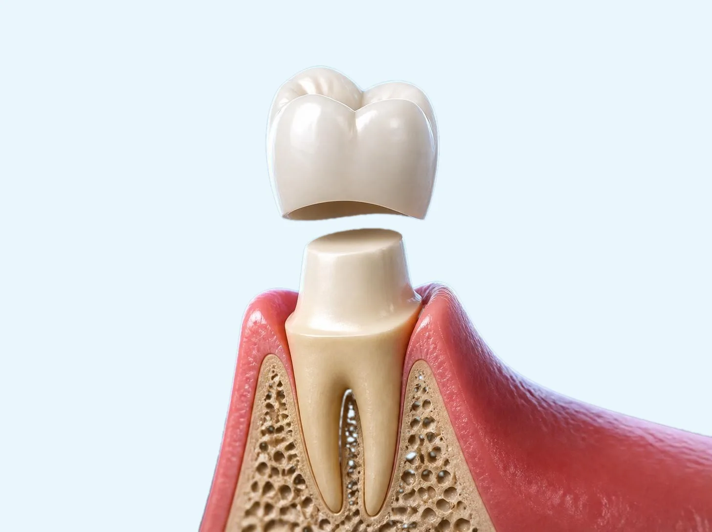 3D illustration of a zirconia crown above a tooth shaped to receive it
