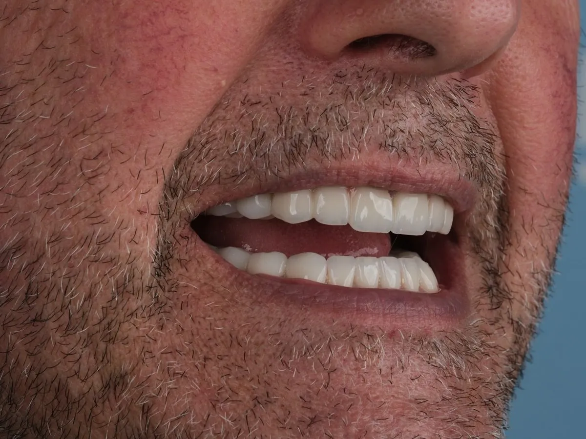 Close-up of a UK Smiles patient smiling with her new zirconia crowns
