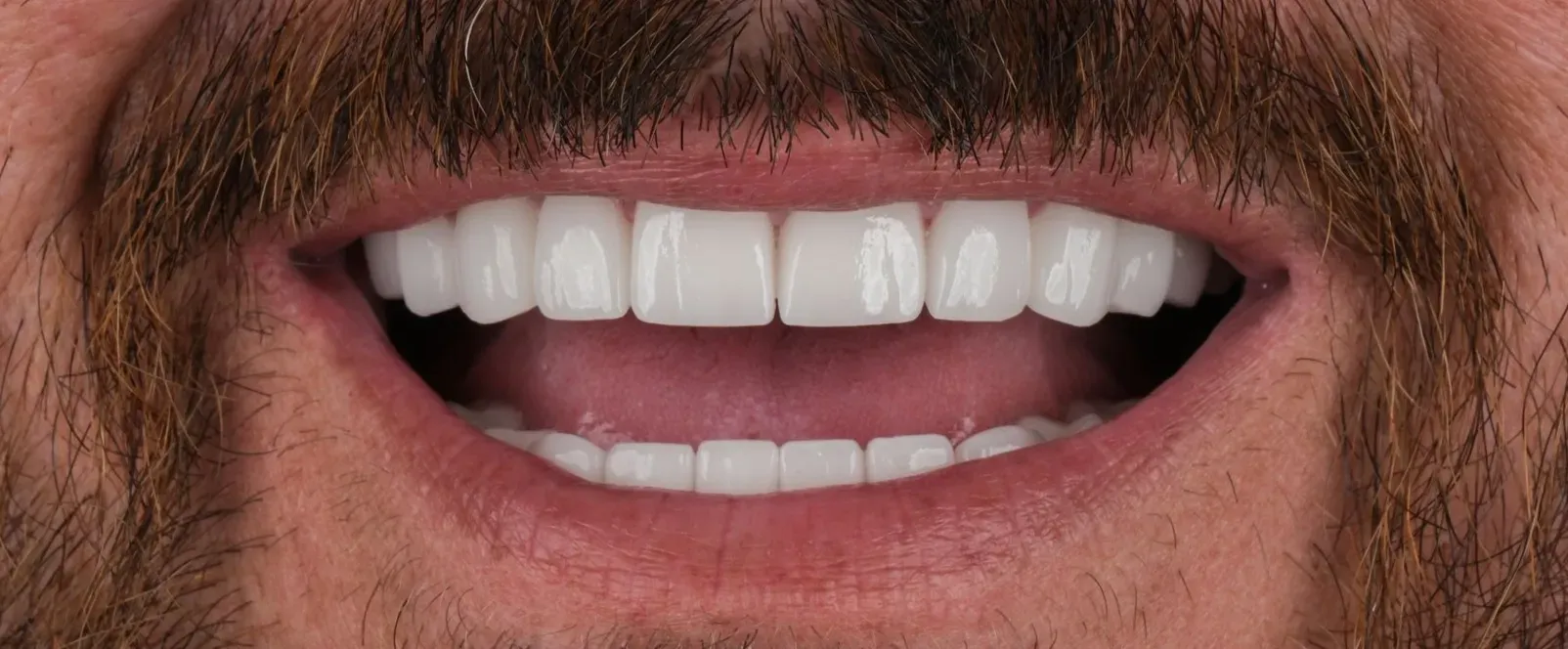 Close-up of a man smiling widely, revealing bright white teeth after zirconia crowns
