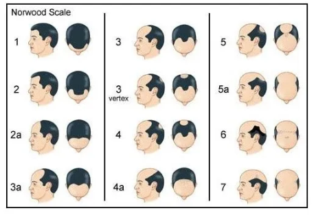 shows the hair transplant norwood scale