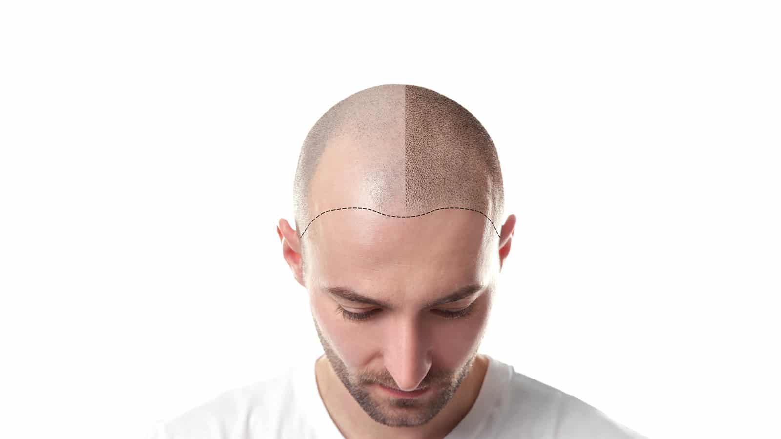 How many grafts do I need for a hair transplant?